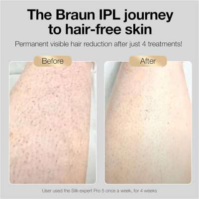 Braun Pro 5 IPL Hair Remover before and after