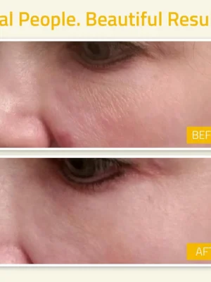 vitamin b-3 serum niacinamide before and after