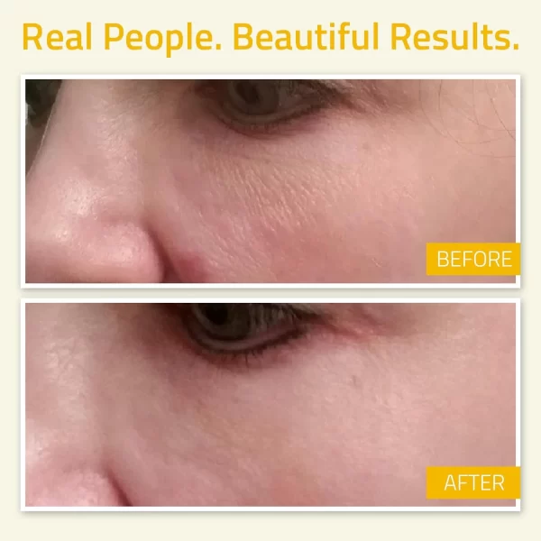 vitamin b-3 serum niacinamide before and after