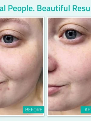 pure hyaluronic serum before & after